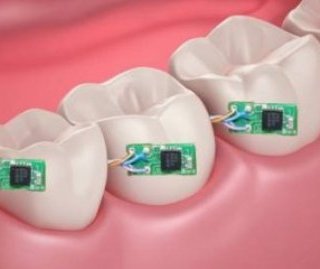 دندانهای ديجيتال
