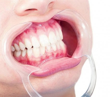 دهان بازکن دو طرفه نعلی شکل C shape  Double Head Cheek Retractor