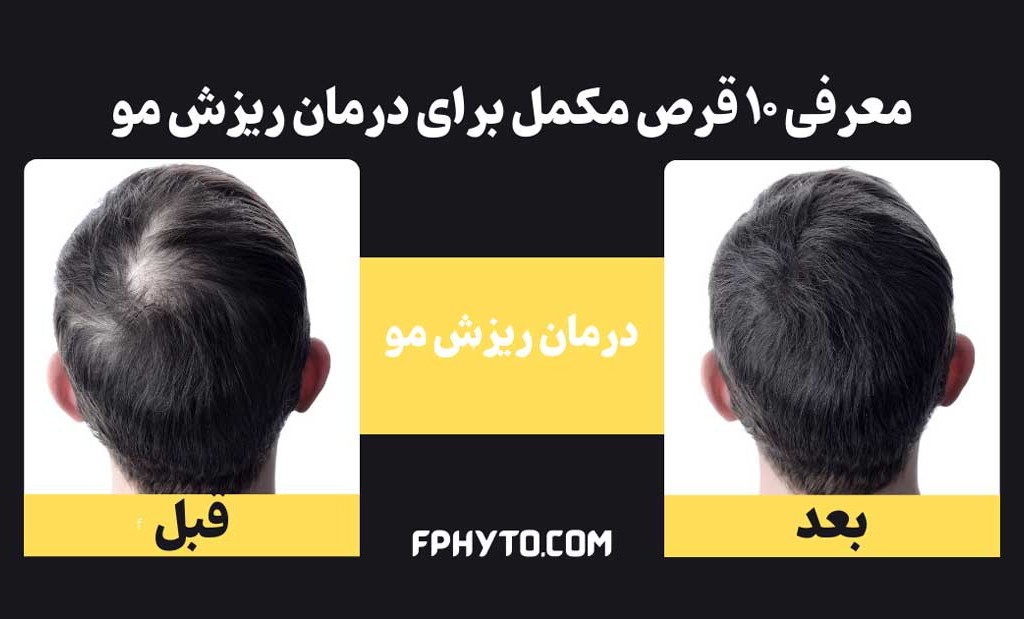 معرفی 10 قرص مکمل برای درمان ریزش مو