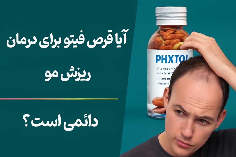 آیا قرص فیتو برای درمان ریزش مو دائمی است؟