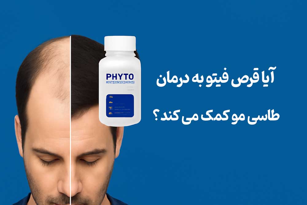 آیا قرص فیتو به درمان طاسی مو کمک می کند؟