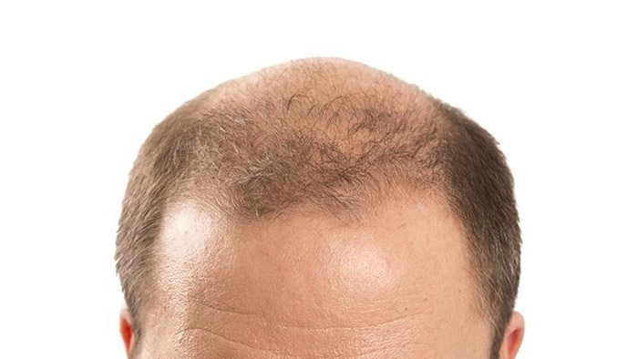 آیا کمبود آهن باعث طاسی می شود؟
