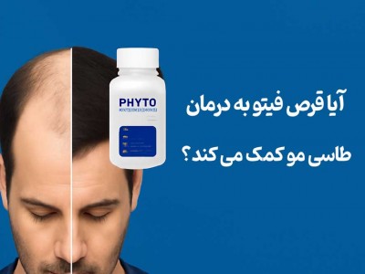 آیا قرص فیتو به درمان طاسی مو کمک می کند؟