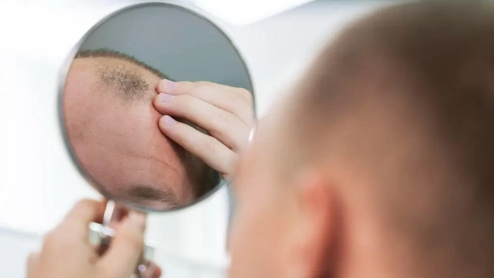 فریتین چه نقشی در ریزش مو دارد؟
