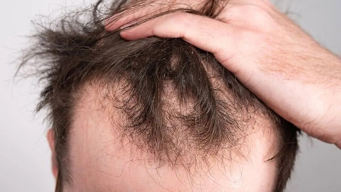 ریزش مو از کمبود ویتامین چه شکلی است؟