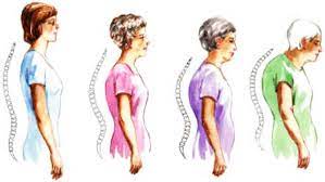 چگونه قوز کمر رو از بین ببریم