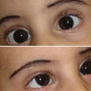 سندرم فلج نگاه خیره اُفقی