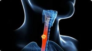 مروری بر سرطان مری