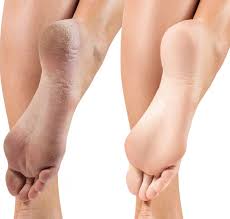 ترک پاشنه پا را با این درمانهای خانگی نابود کنید