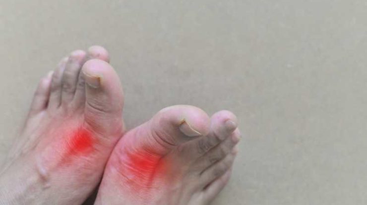 غذاهای مناسب نقرس