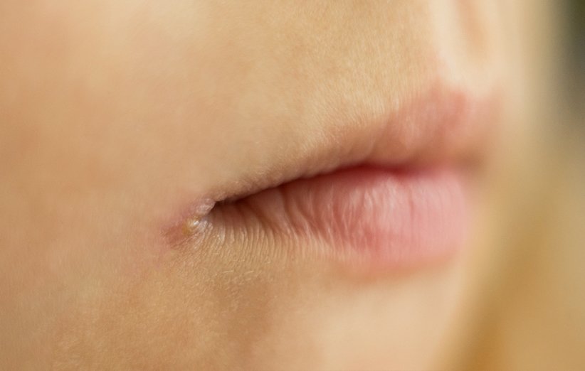 علت ترک گوشه‌ی لب چیست؟