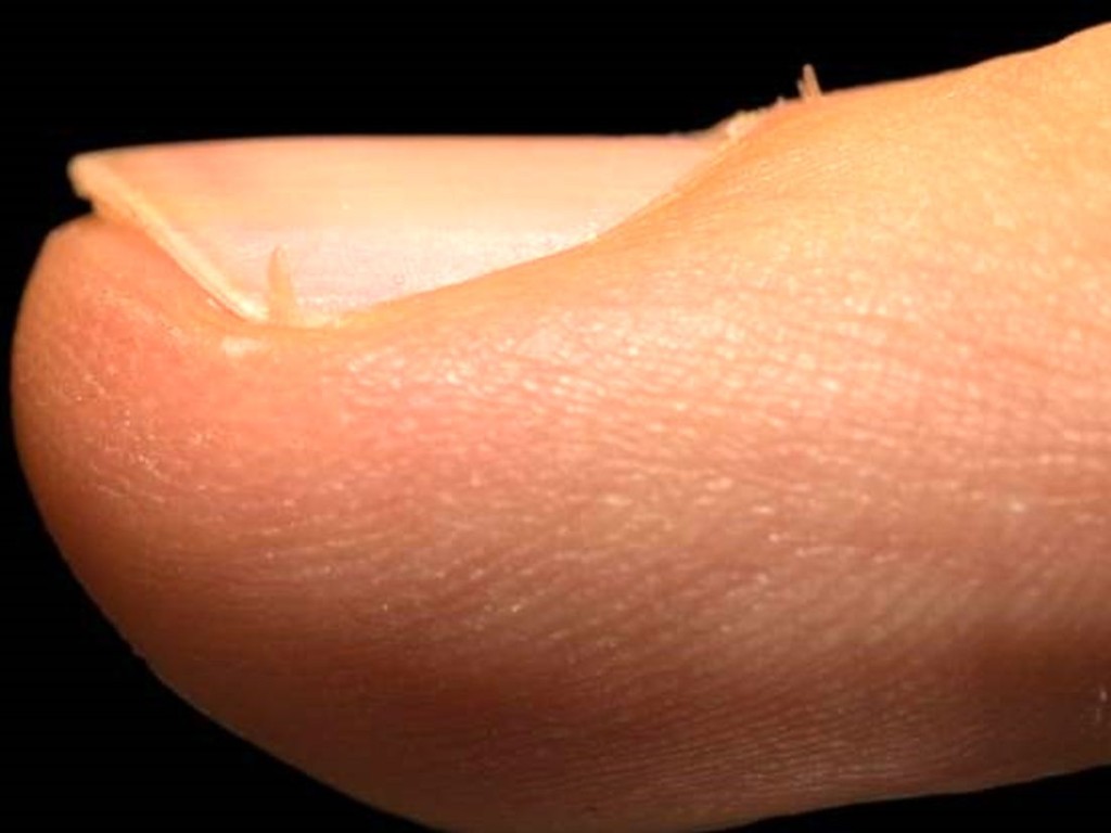 علت ریش ریش شدن گوشه‌های ناخن چیست؟