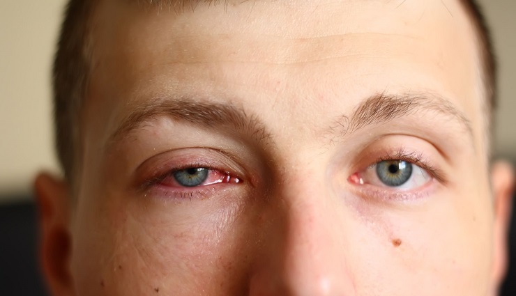 چشم صورتی؛ هرآنچه باید درباره این بیماری بدانید