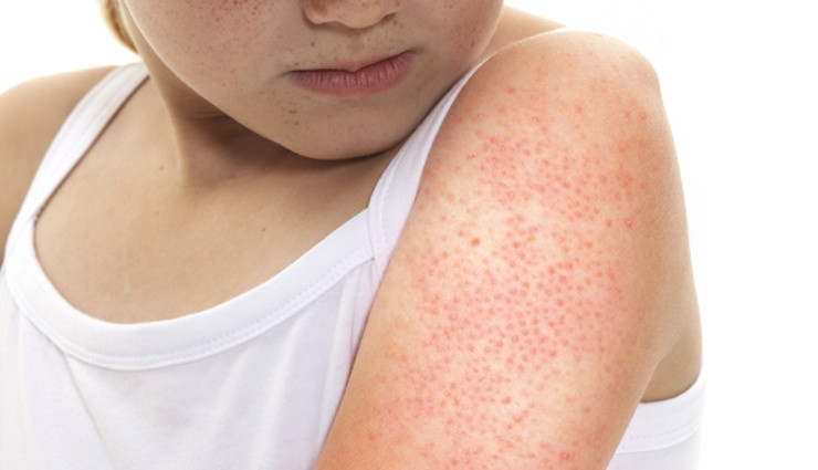 پوست مرغی شدن پوست؛ از تشخیص تا درمان