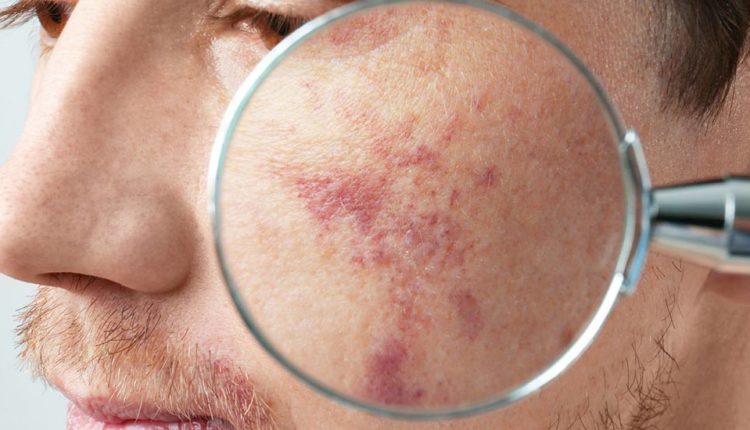 ملاسما چیست؛ علل ایجاد و درمان این بیماری