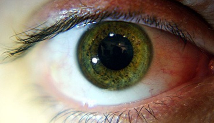 مردمک چشم و بیماری‌های مؤثر بر آن