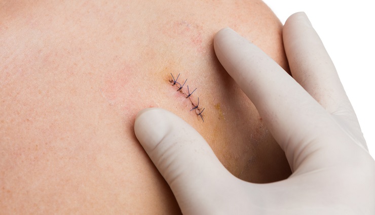 مراقبت از بخیه؛ نکات مهم و نشانه‌های هشدار