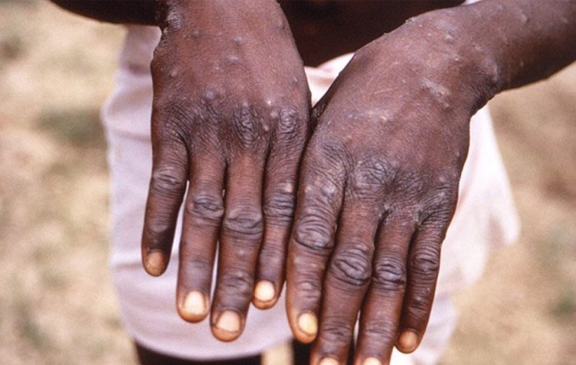 آبله میمون چیست و آیا باید نگران شیوع آن باشیم؟