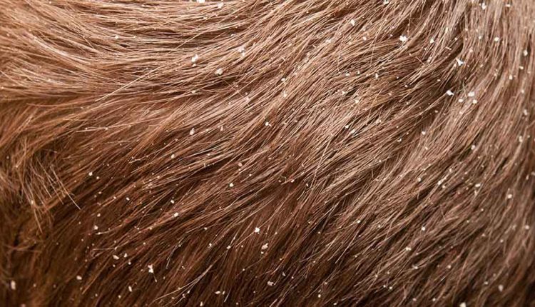 درمان شوره سر با ۱0 روش ساده و طبیعی