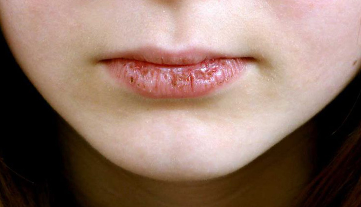 دلایل خشکی دهان و راه‌های درمان آن