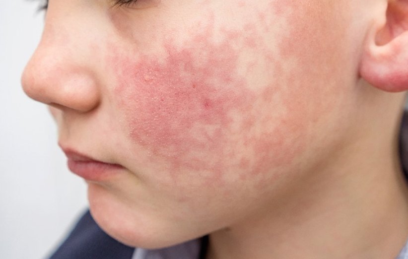 حساسیت به خورشید چیست و چه تفاوتی با آفتابسوختگی دارد؟