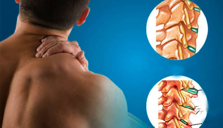 اسپوندیلوز؛ علائم، تشخیص و درمان