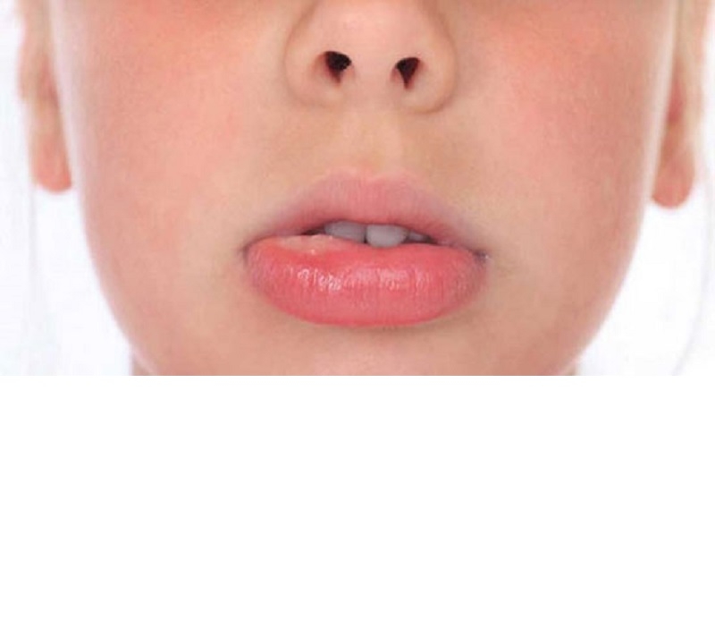 آنچه که باید در مورد برفک روی لب‌ها باید بدانید