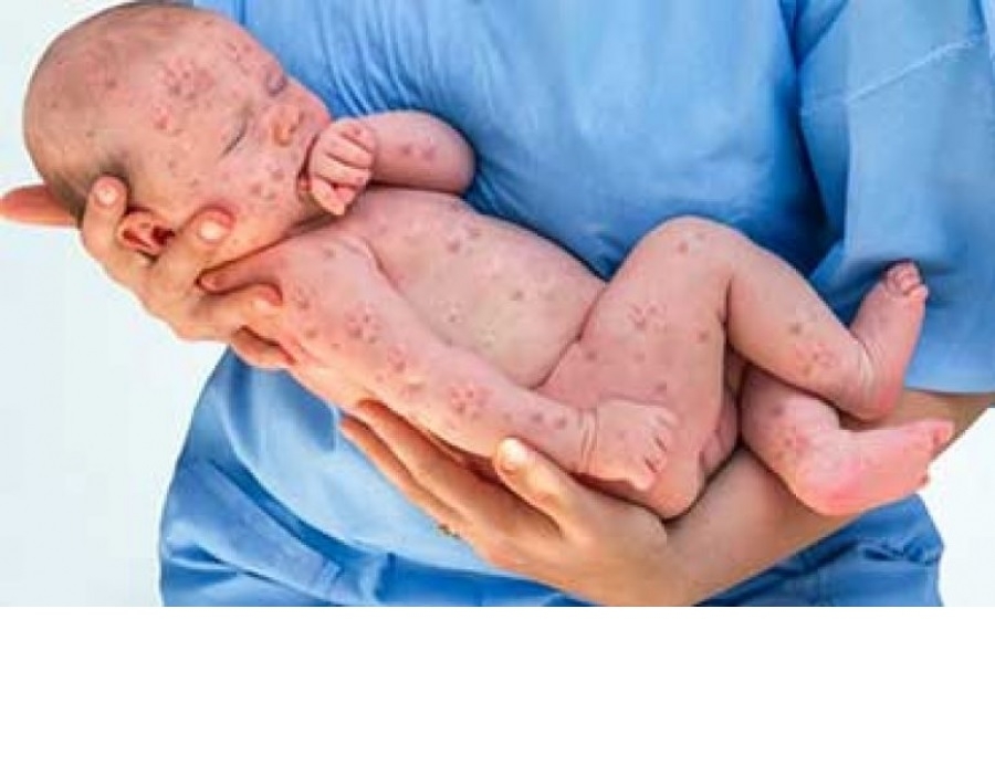 آنچه باید در مورد آبله میمونی و بارداری بدانید