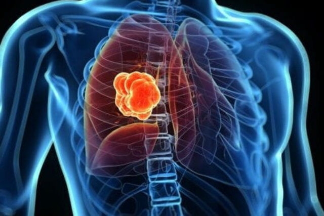 نکاتی درباره سرطان ریه