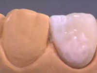 کاربردهای کوره در دندانسازی