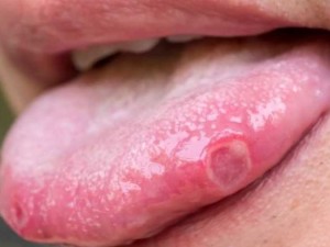 آیا آفت دهان خطرناک است؟