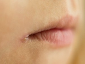 علت ترک گوشه‌ی لب چیست؟