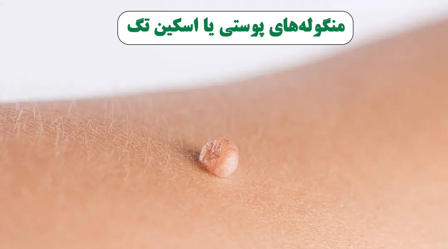 آیا منگوله های گوشتی با ظاهری ناخوشایند حاوی اخباری از درون بدنمان هستند؟!