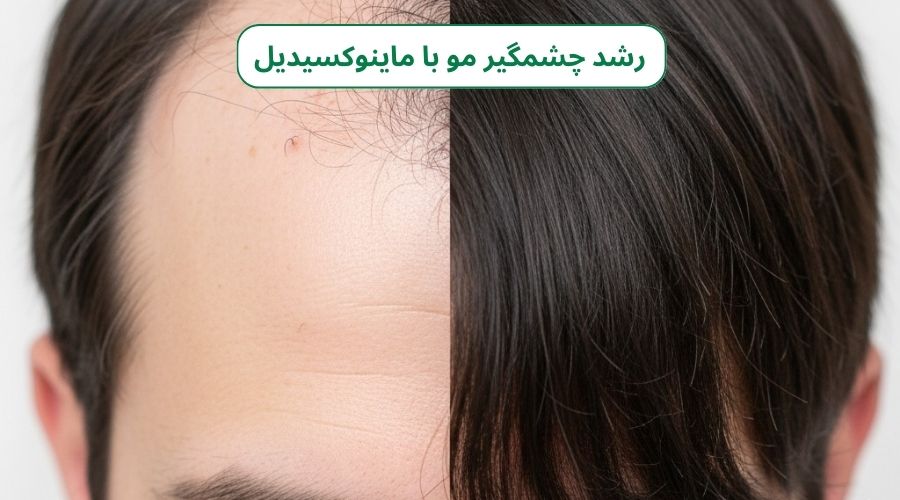 ماینوکسیدیل؛ ناجی موهای شما یا یک شمشیر دولبه؟