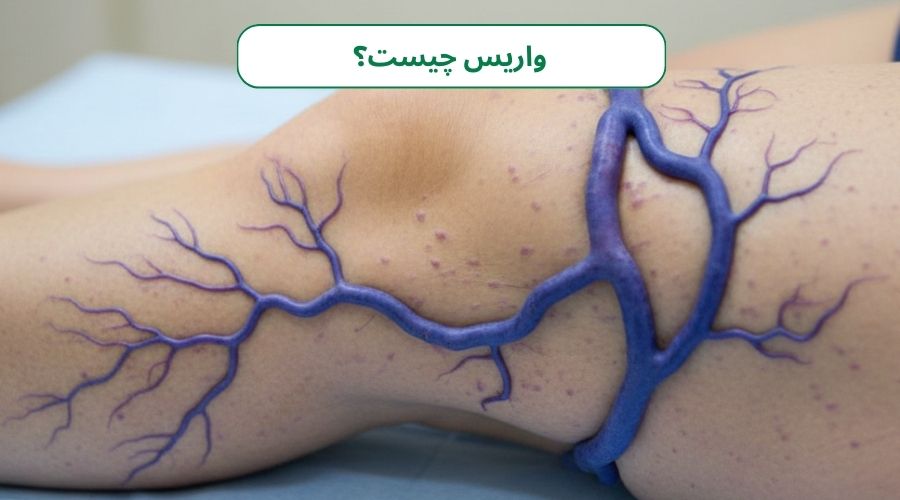 رگهای پیچخورده: آیا واریس درمان دارد؟