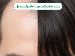 ماینوکسیدیل؛ ناجی موهای شما یا یک شمشیر دولبه؟