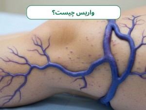 رگ‌های پیچ‌خورده: آیا واریس درمان دارد؟