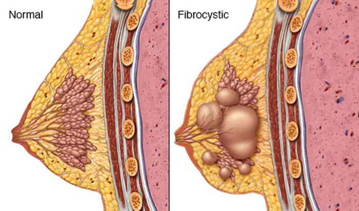 بیماری فیبروکیستیک پستان