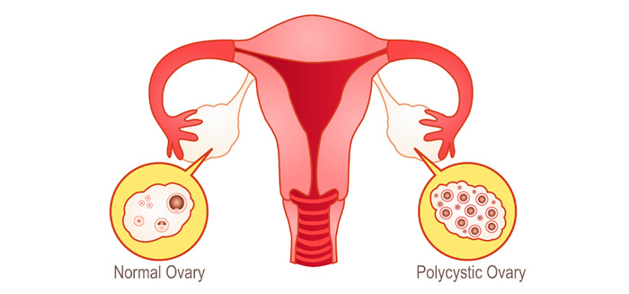 درمان‎های کمکی برای تخمدان پلی کیستیک