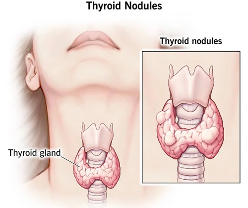 بزرگ شدن غده تیروئید