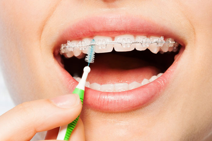 چگونه دندان‌های ارتودنسی را نخ دندان بکشیم؟