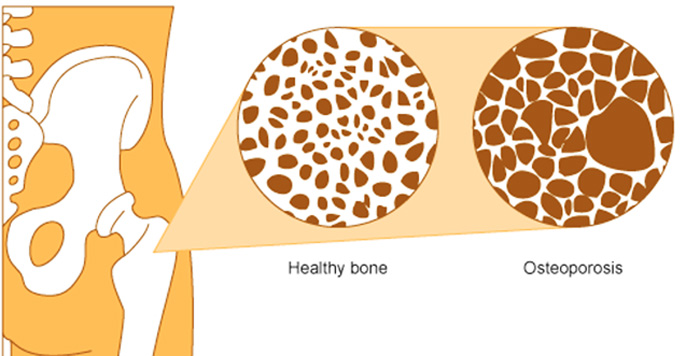 پوکی استخوان