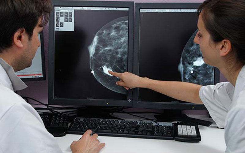 سرطان پستان متاستاتیک 