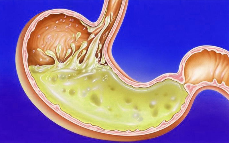 رفلاکس اسید معده