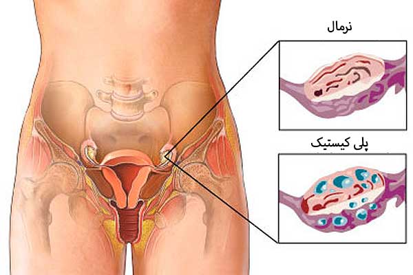 تخمدان پلی کیستیک