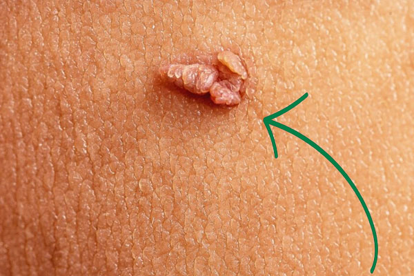 منگوله های گوشتی چیست؟