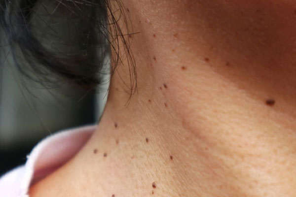ناثیر عوامل ژنتیکی در بروز منگوله‌های گوشتی