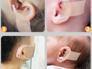 چسب فرم دهی و اصلاح گوش نوزاد alke