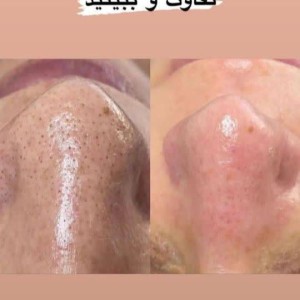 ماسک زغال مایسا