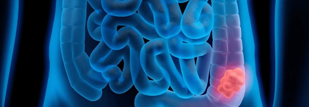 سرطان کولون (ریسک فاکتور،تشخیص)